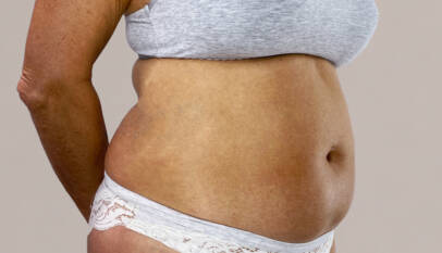 Abdominoplasty Dubai