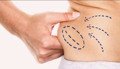 Liposuction in Dubai