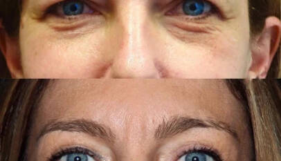 Blepharoplasty in Dubai