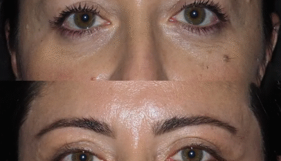 Eye Bag Removal in Dubai