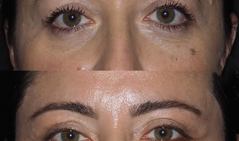 Eye Bag Removal in Dubai