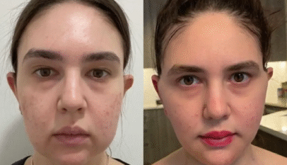 Buccal Fat Removal in Dubai