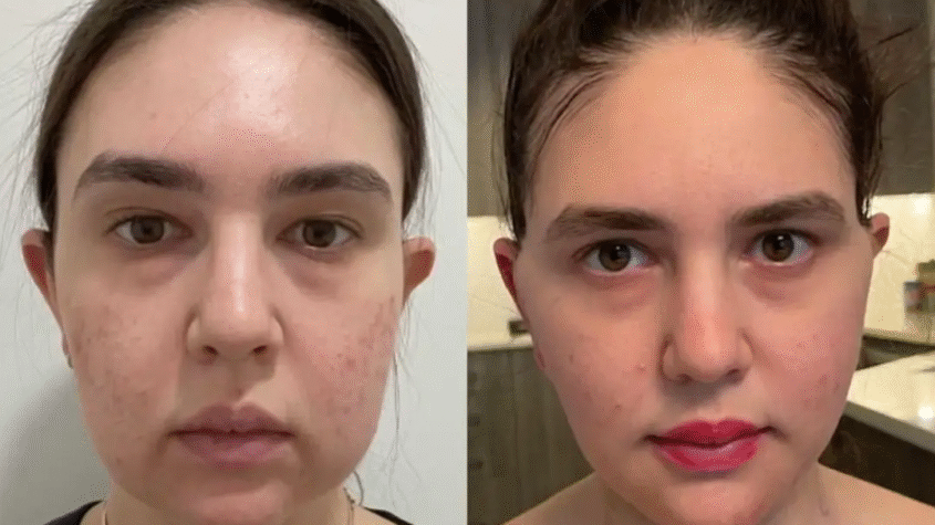 Buccal Fat Removal in Dubai