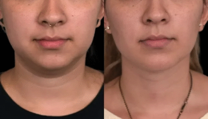 Double chin removal in Dubai