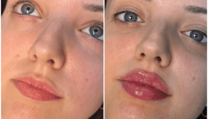 Juvederm in Dubai