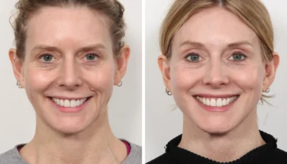 Thread lift in Dubai