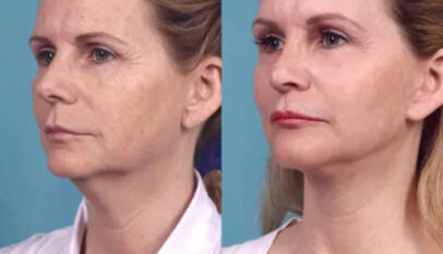 Chemical Peel in Dubai
