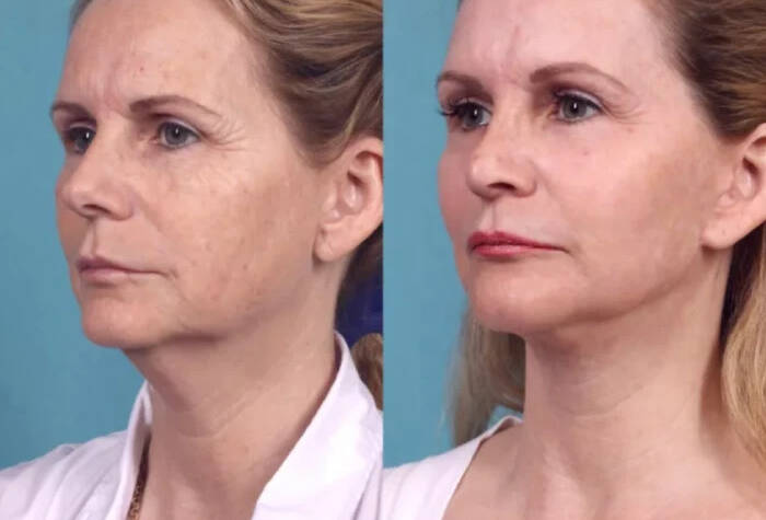 Chemical Peel in Dubai