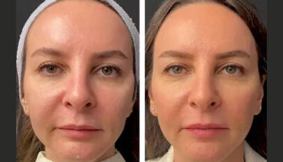 Mesotherapy in Dubai