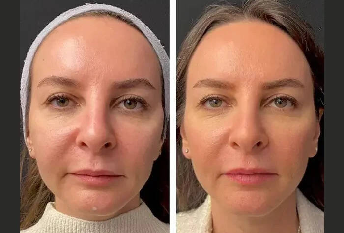 Mesotherapy in Dubai