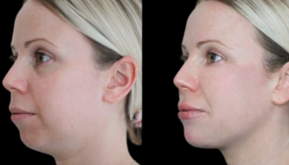 Jawline Fillers in Dubai