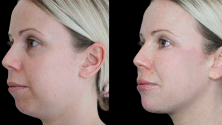 Jawline Fillers in Dubai