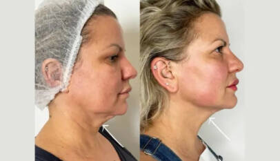 How Endolift Treatment in Dubai Stimulates Collagen Naturally