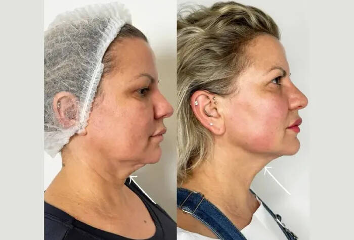 How Endolift Treatment in Dubai Stimulates Collagen Naturally