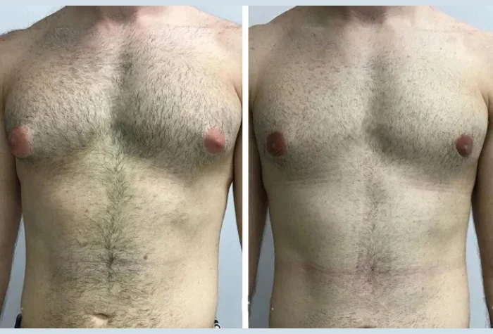 Gynecomastia in Dubai