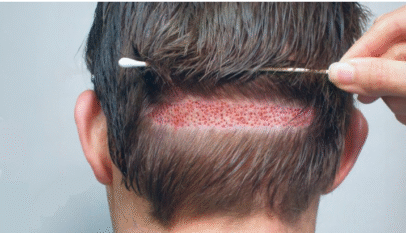 Hair Transplant Pakistan