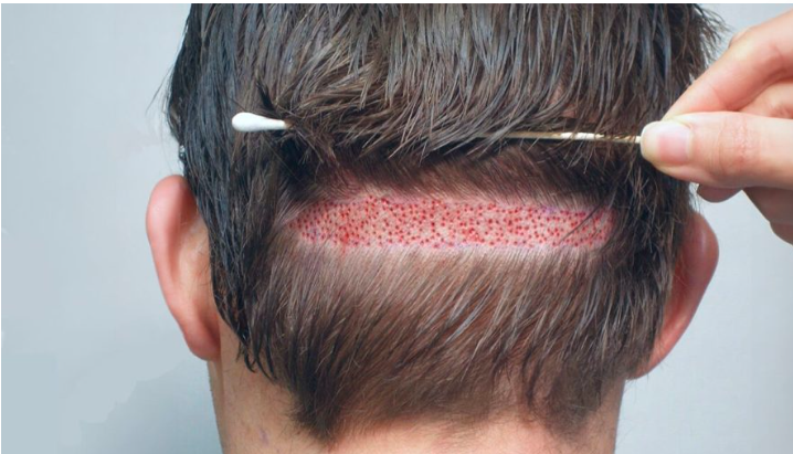 Hair Transplant Pakistan