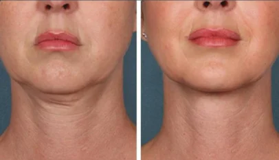 PRP Treatment in Dubai