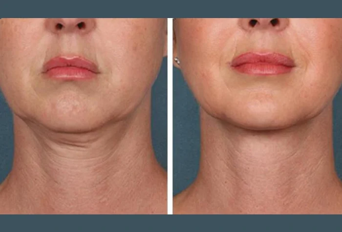 PRP Treatment in Dubai