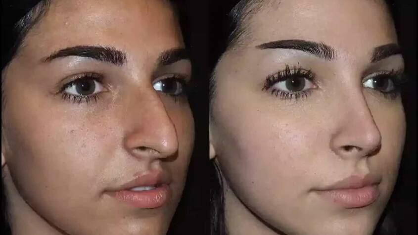 Septoplasty in Dubai