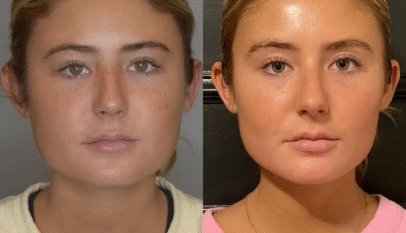 Buccal Fat Removal in Dubai