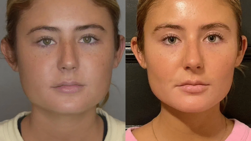 Buccal Fat Removal in Dubai