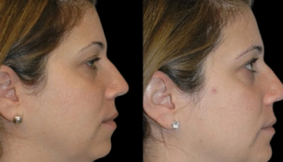 Double chin removal in Dubai
