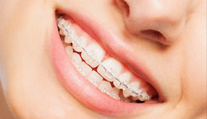 Invisalign Dubai