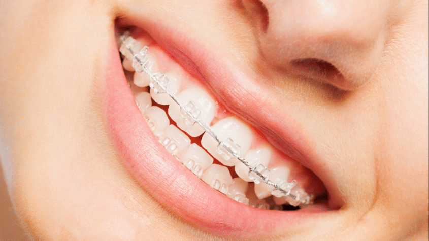 Invisalign Dubai