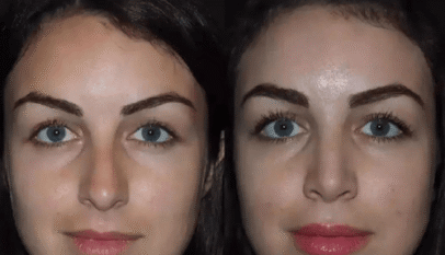 rhinoplasty in Dubai