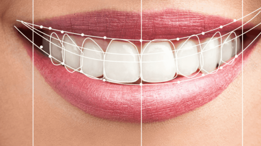 Digital Smile Design Dubai