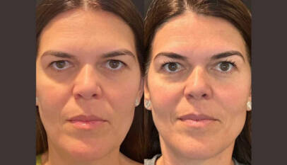 Thread lift in Dubai