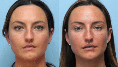 Thread Lift in Dubai