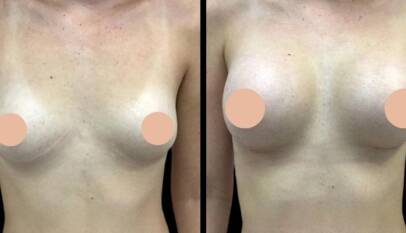 Breast augmentation in Dubai